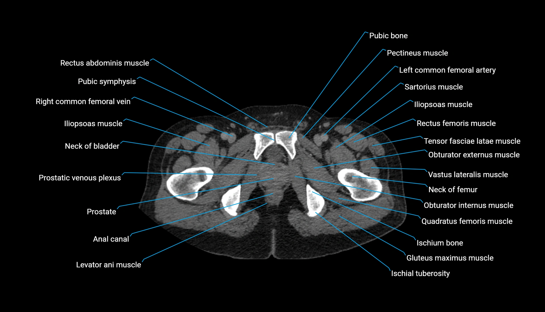 CT urogram axial cross sectional anatomy  labelled radiology image-00252.webp